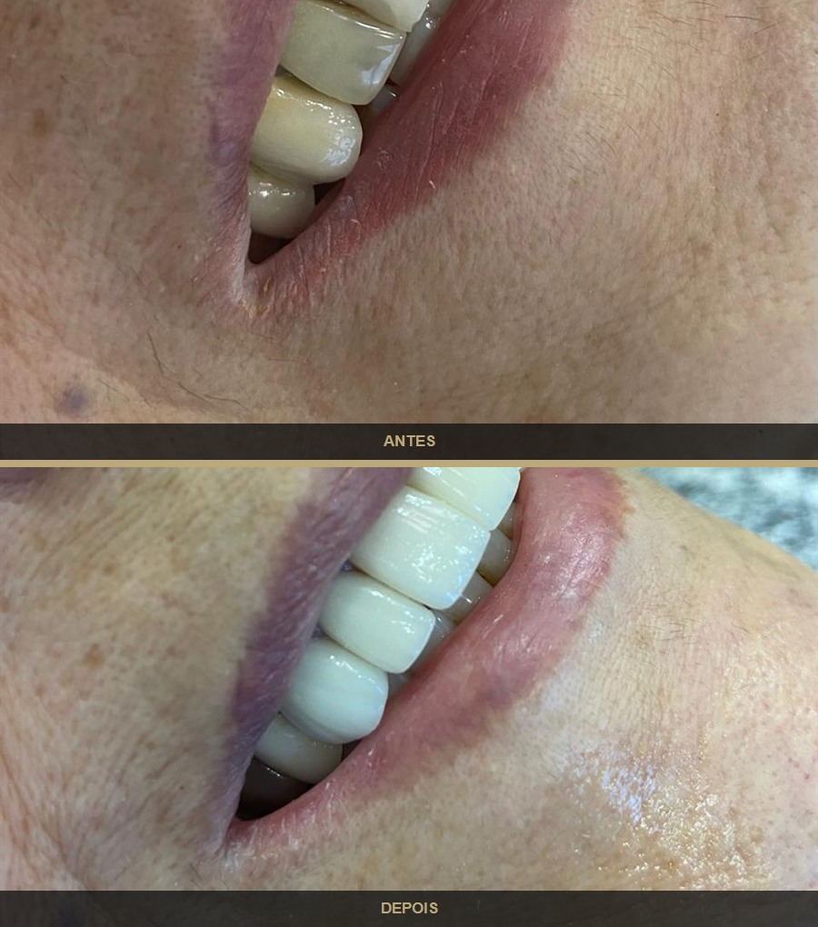 Antes e depois — caso 6