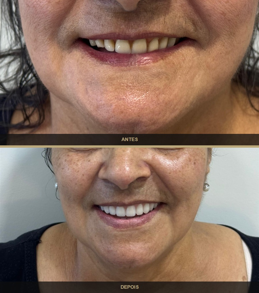 Antes e depois — caso 9