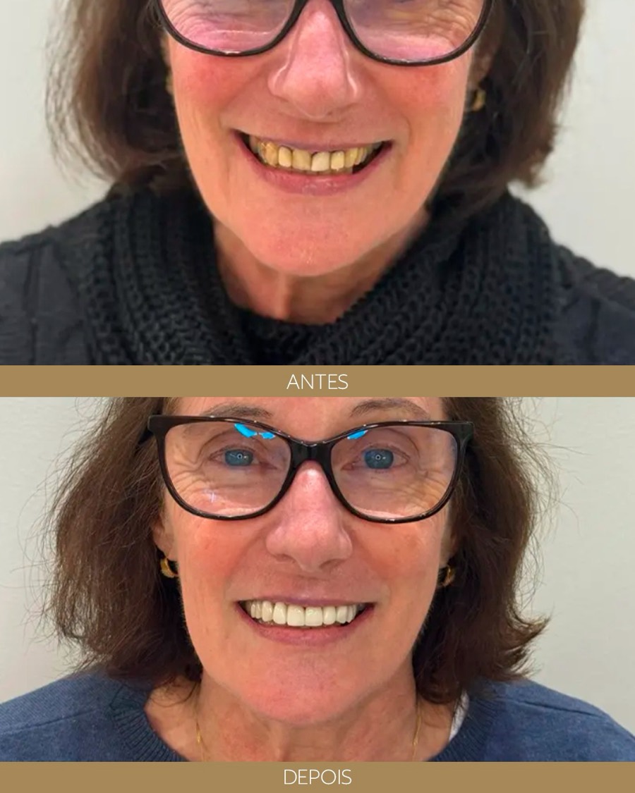 Antes e depois — depoimento