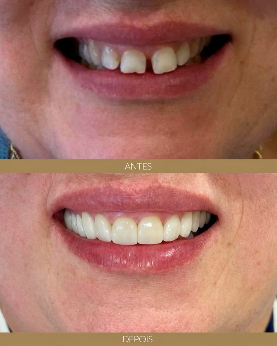 Antes e depois — depoimento