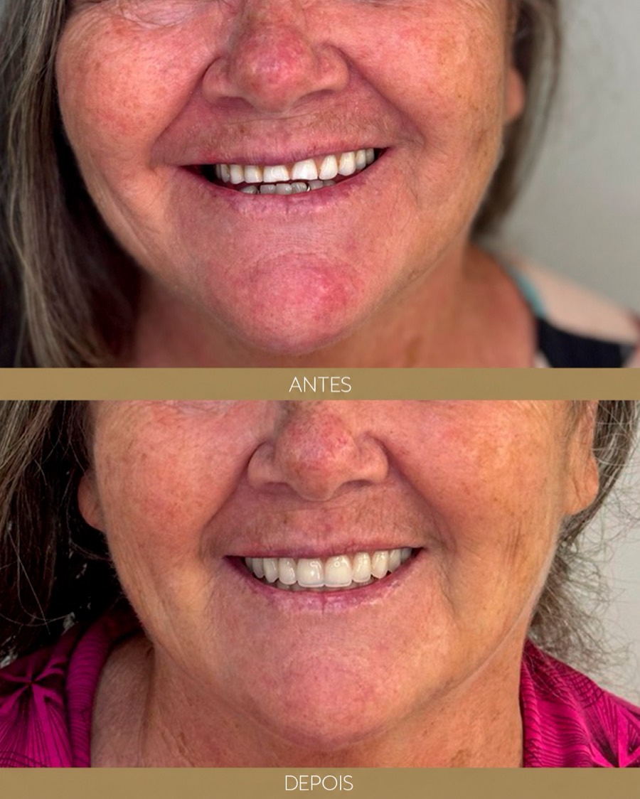 Antes e depois — depoimento