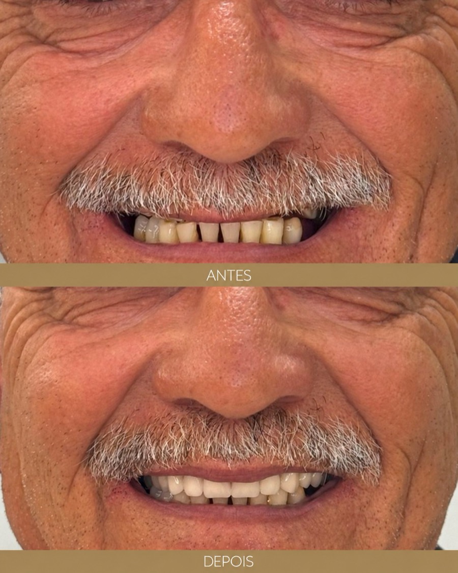 Antes e depois — depoimento