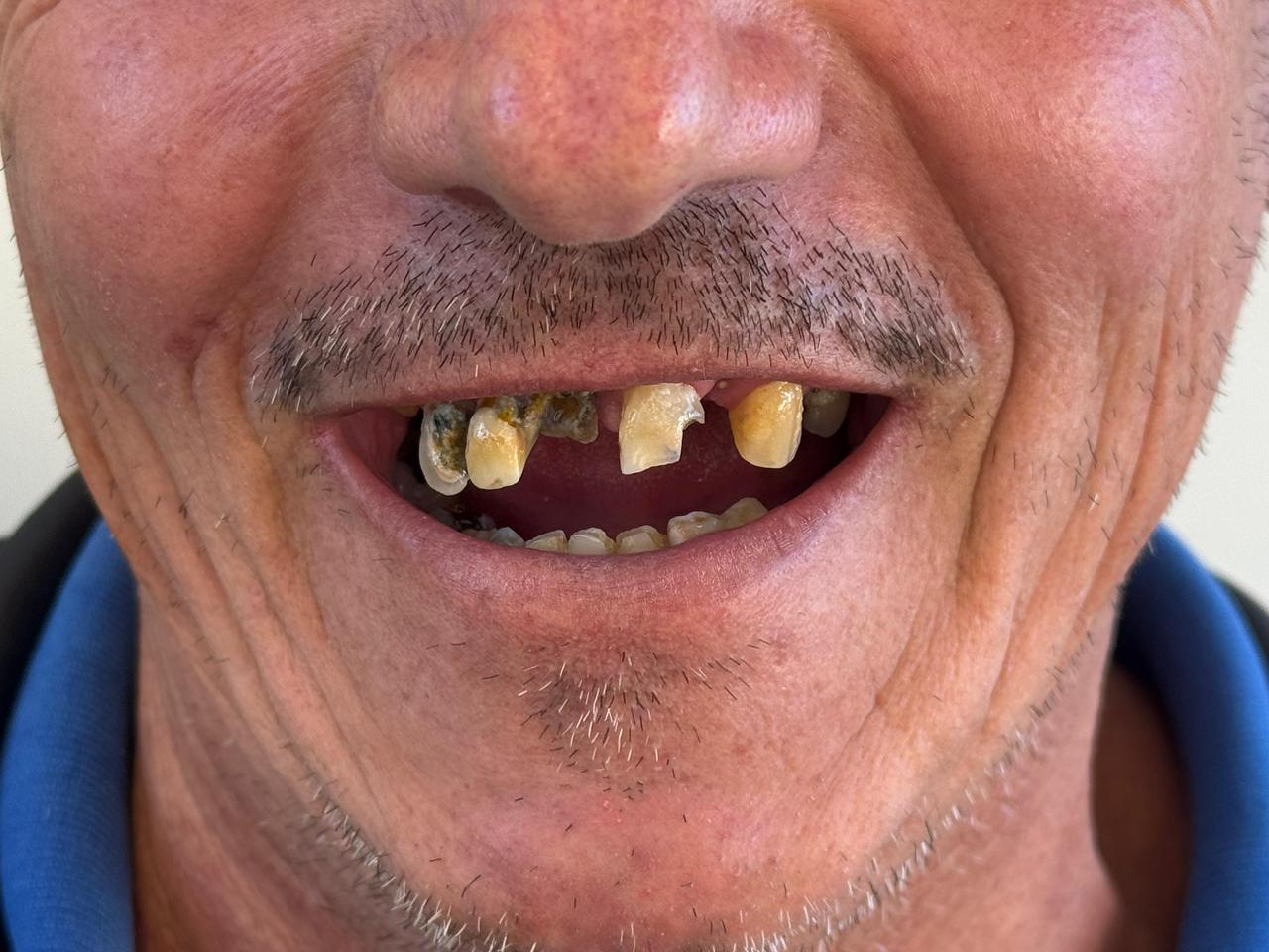 Sorriso antes do tratamento na Vallure Odontologia