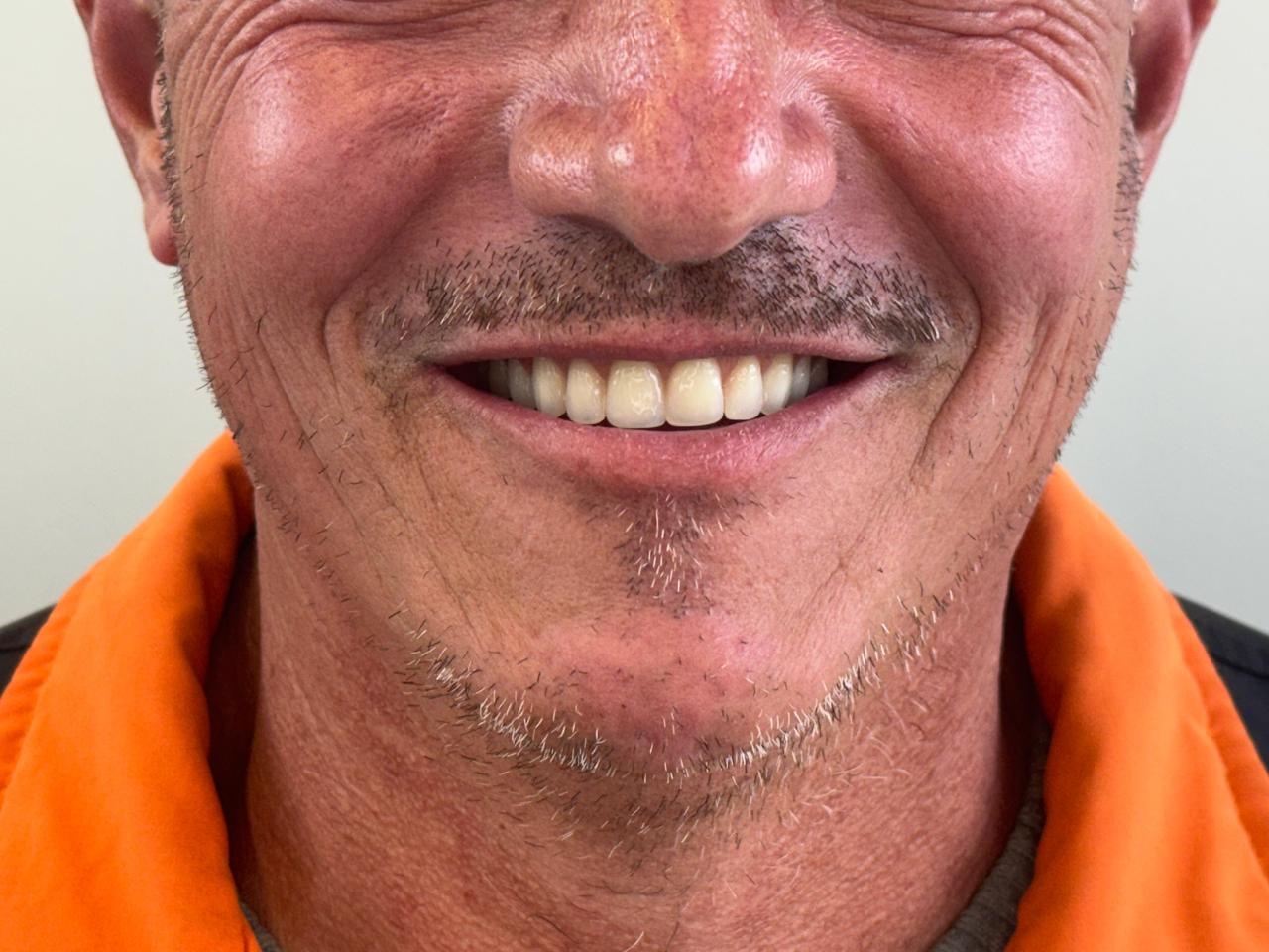 Sorriso depois do tratamento na Vallure Odontologia